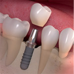 Mercury Free Dentistry