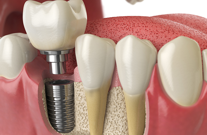 Dental Implants in Melbourne