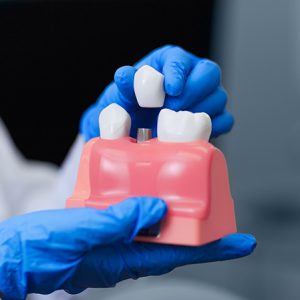 Doctor-Holding-Model-Of-Teeth