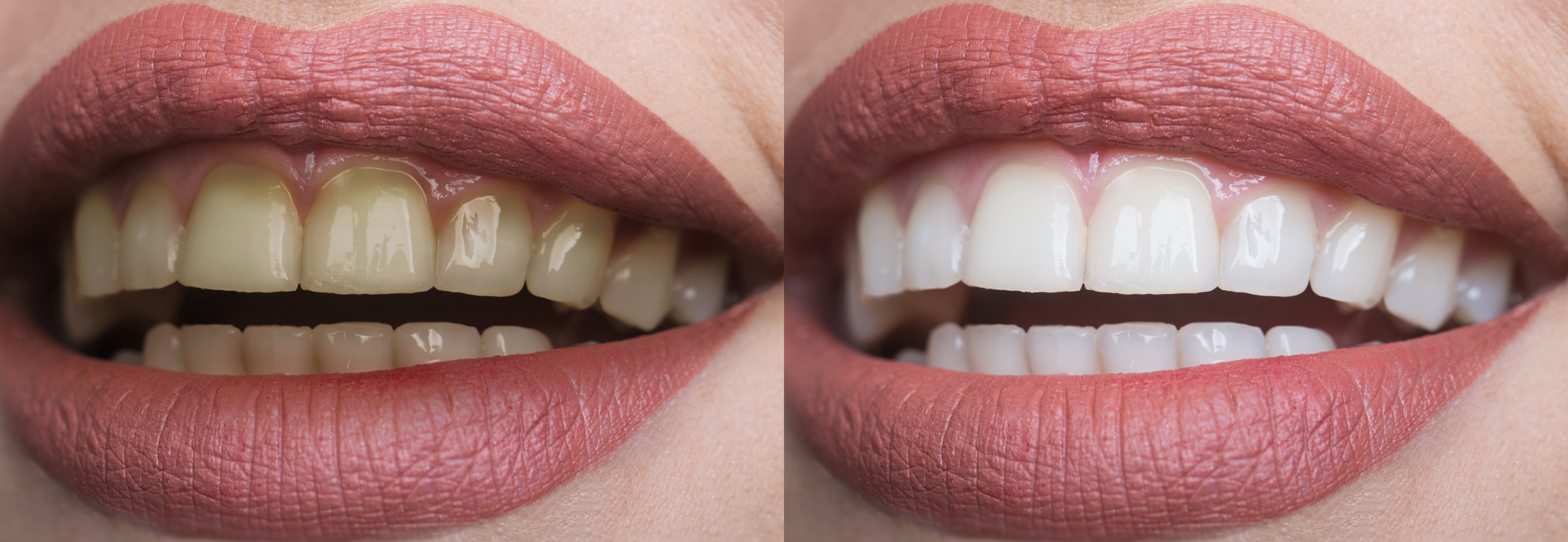 Teeth-Whitening Melbourne
