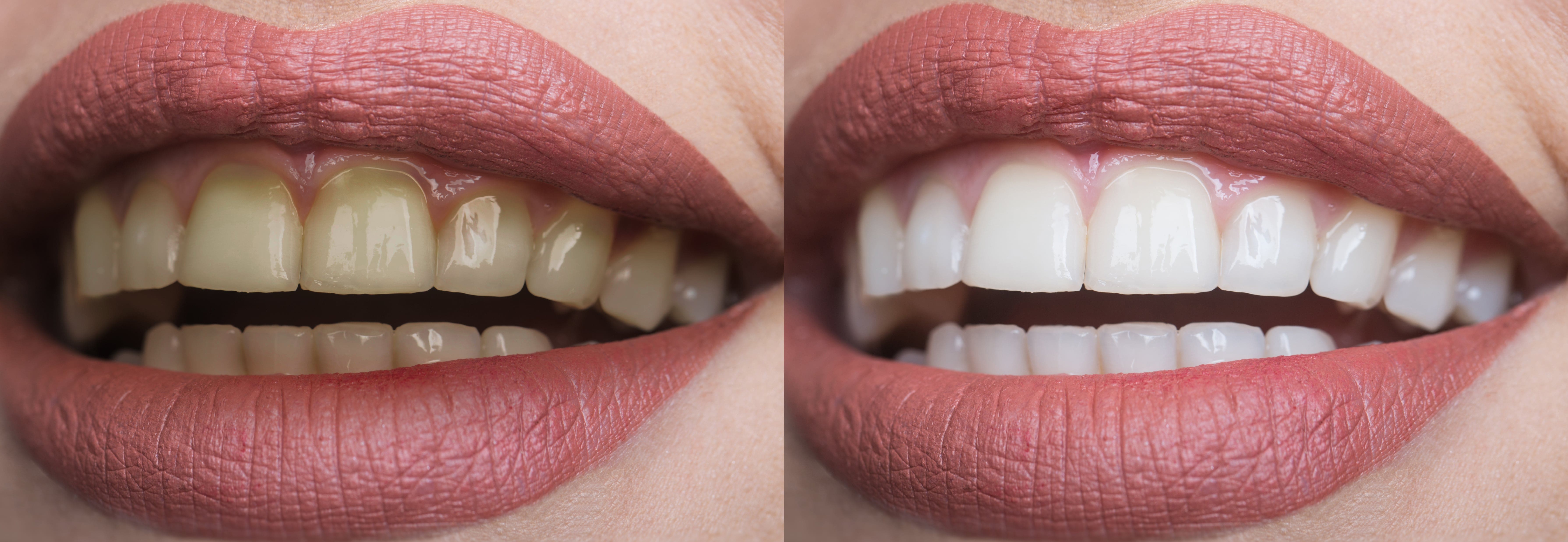 teeth whitening in Melbourne