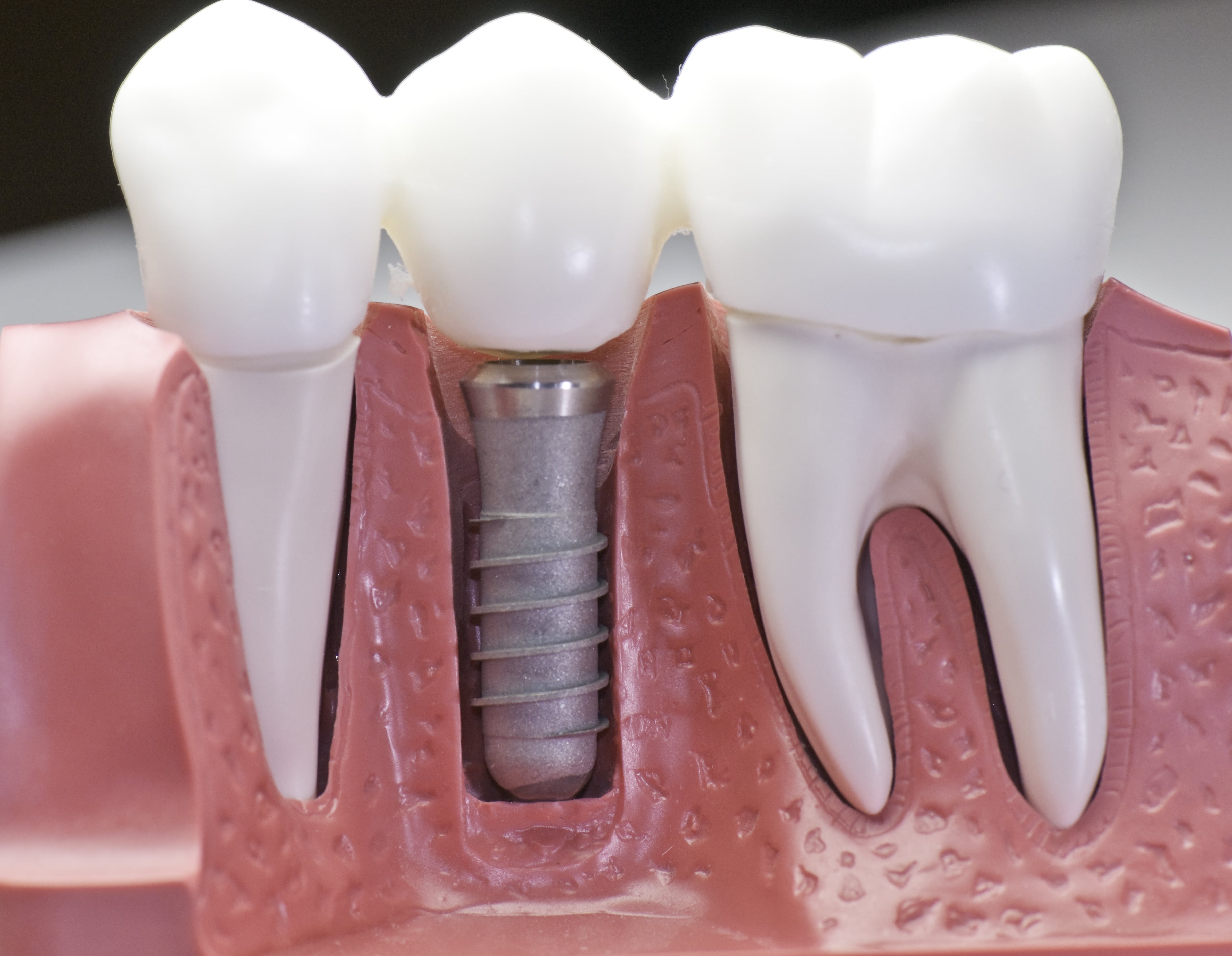 Dental-Implants Melbourne