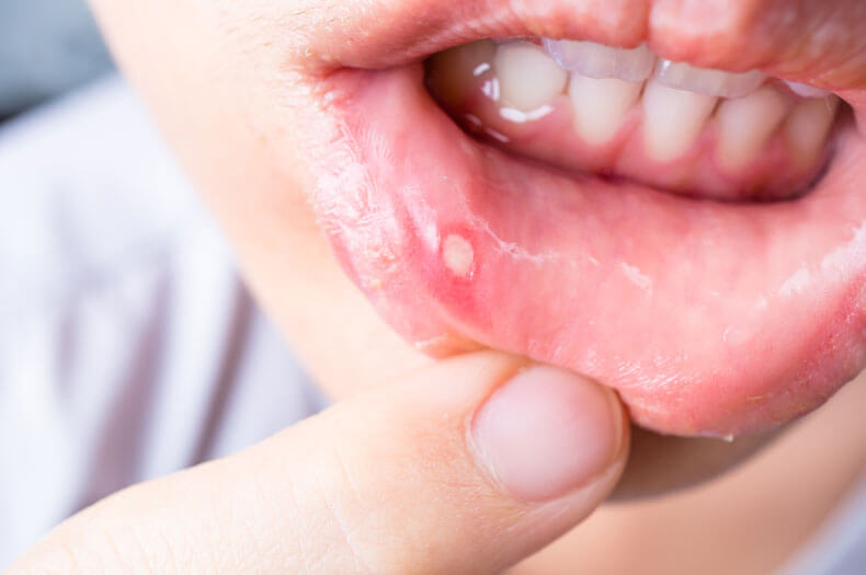 mouth-ulcers