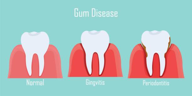 Gum Disease Treatment